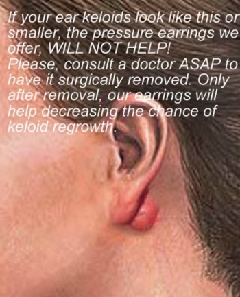 Patients' left ear after keloid excision with silicon pressure splint... |  Download Scientific Diagram